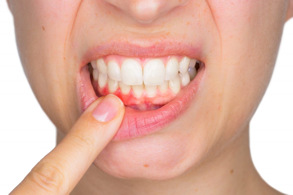 Signs of gum inflammation and redness in the mouth – how to know if you have gum disease Close-up of swollen, red gums being examined as a common symptom of periodontal issues – how to know if you have gum disease
