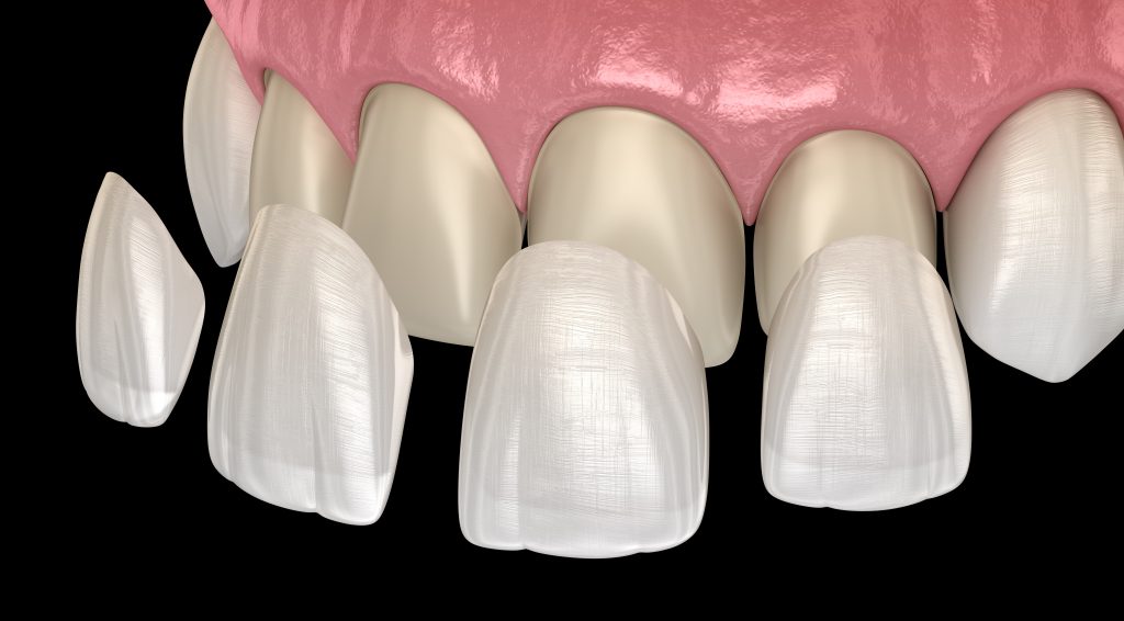 Porcelain veneer placement illustration showing cosmetic tooth enhancement – dental veneer Detailed illustration of individual porcelain shells placed over front teeth for smile improvement – dental veneer