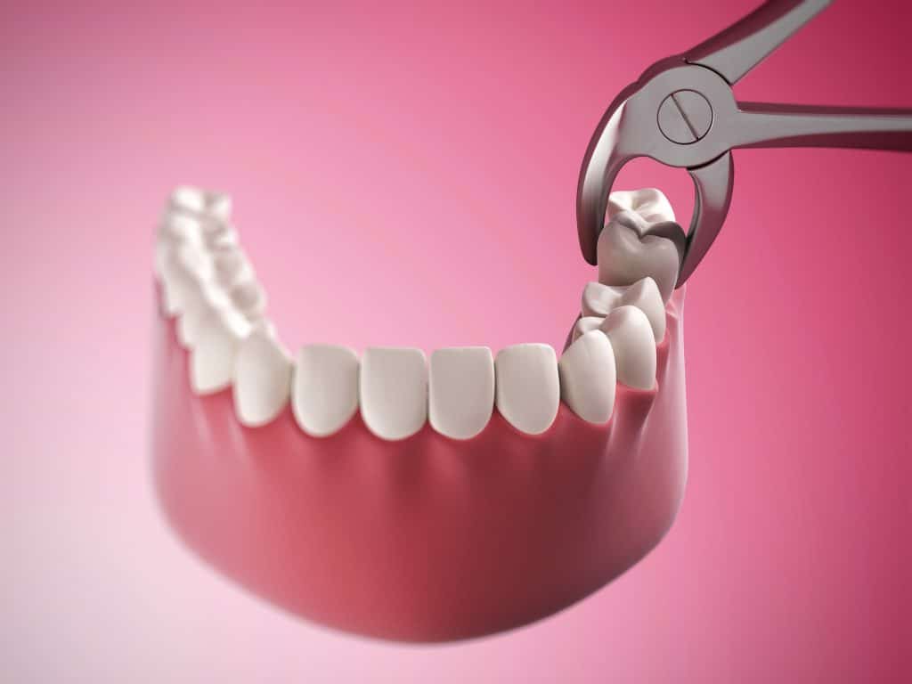 Dental illustration showing tooth extraction process with forceps – how do you pull a tooth 3D illustration of a tooth being removed from the jaw using dental forceps – how do you pull a tooth