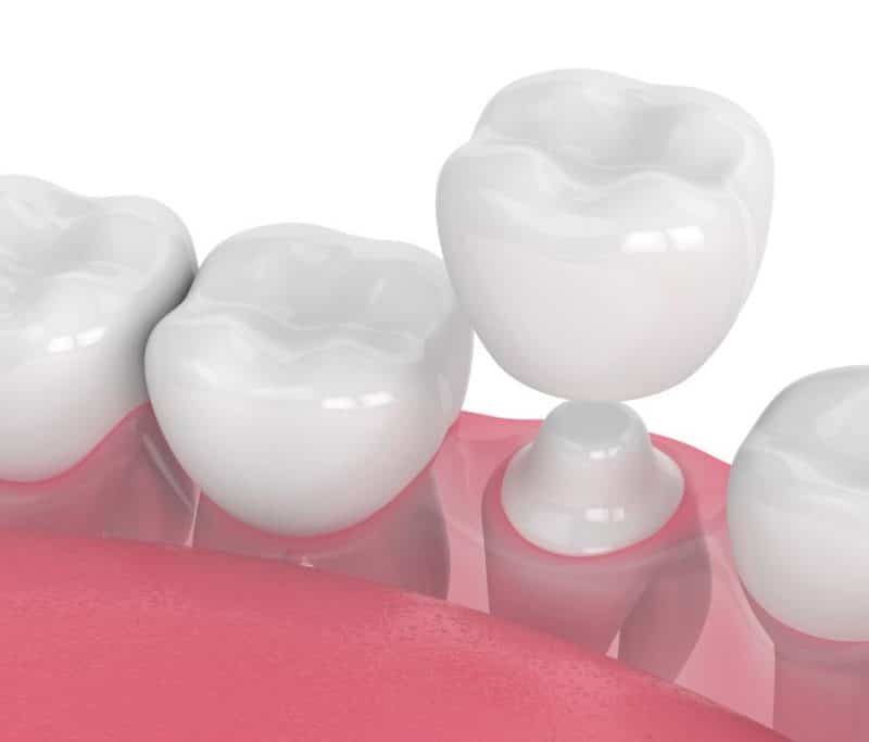 Illustration of a dental crown being placed on a treated tooth following a root canal procedure – how soon after root canal to get crown