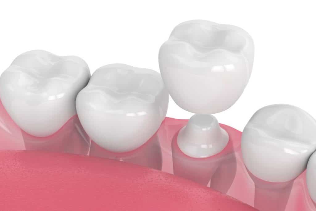 Dental crown placement after root canal treatment timeline – how soon after root canal to get crown Illustration of a dental crown being placed on a treated tooth following a root canal procedure – how soon after root canal to get crown