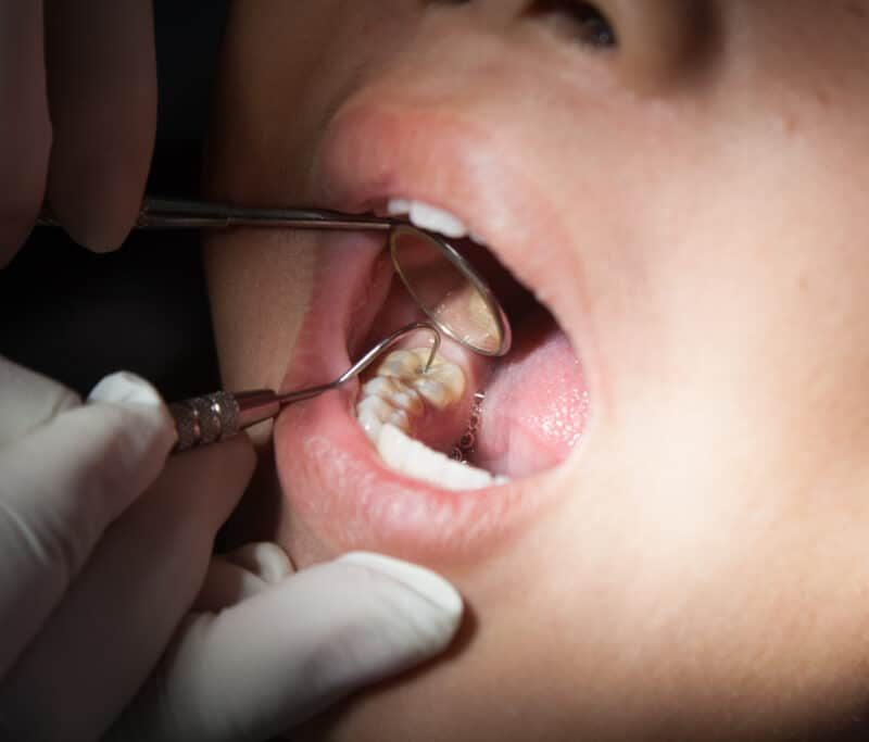 Close-up of a dentist examining and preparing a tooth for protective dental treatment – sealant for teeth