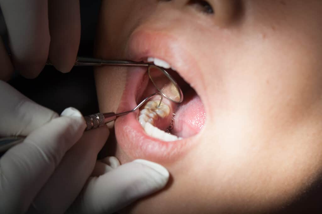 Dental professional applying protective coating to a molar surface – sealant for teeth Close-up of a dentist examining and preparing a tooth for protective dental treatment – sealant for teeth