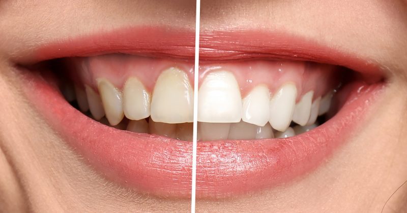 Side-by-side comparison of a smile highlighting improved tooth shape and symmetry – dental reshaping before and after
