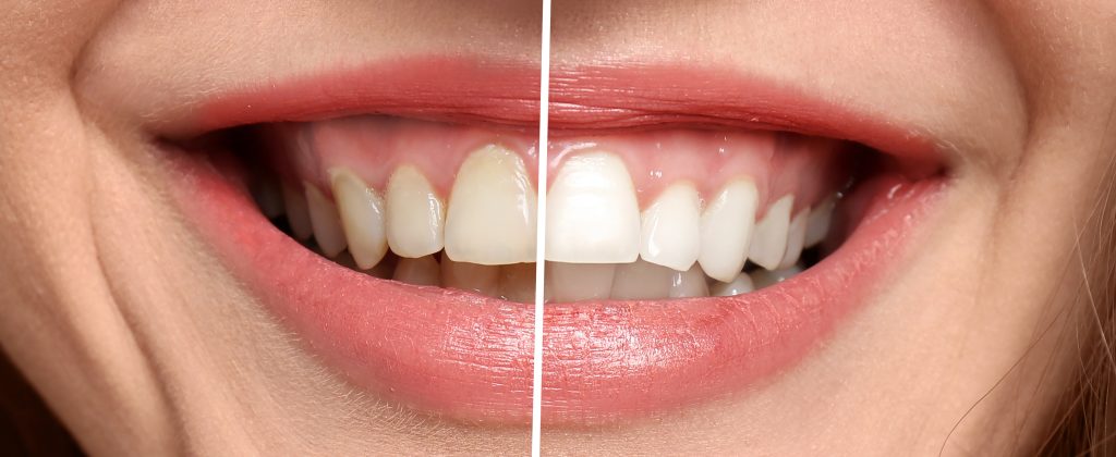 Smile transformation showing cosmetic tooth contouring results – dental reshaping before and after Side-by-side comparison of a smile highlighting improved tooth shape and symmetry – dental reshaping before and after