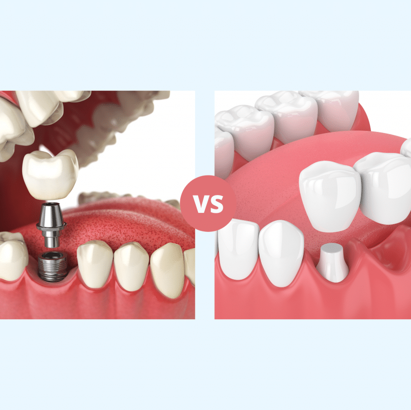 Side-by-side illustration comparing a dental implant and a dental bridge as tooth replacement options – dental implant vs bridge