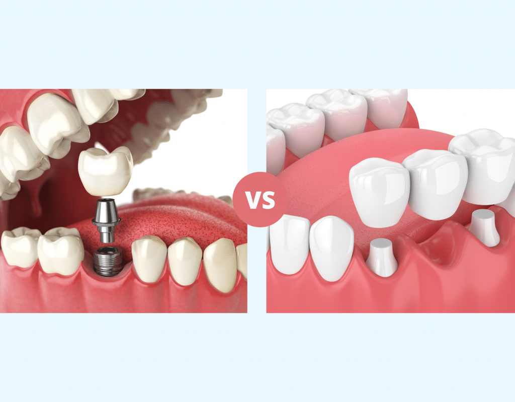 Dental implant vs bridge comparison for missing teeth – dental implant vs bridge Side-by-side illustration comparing a dental implant and a dental bridge as tooth replacement options – dental implant vs bridge